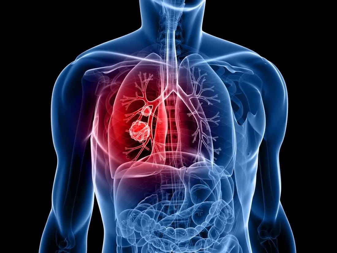 Devrim Niteliğindeki Yeni Akciğer Kanseri İlacı, Osimertinib: Ölüm Riskini Yüzde 50 Azaltıyor