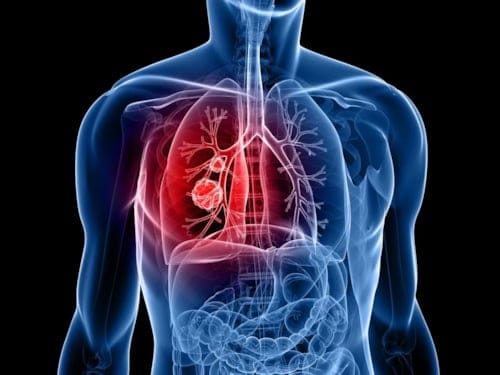 Devrim Niteliğindeki Yeni Akciğer Kanseri İlacı, Osimertinib: Ölüm Riskini Yüzde 50 Azaltıyor