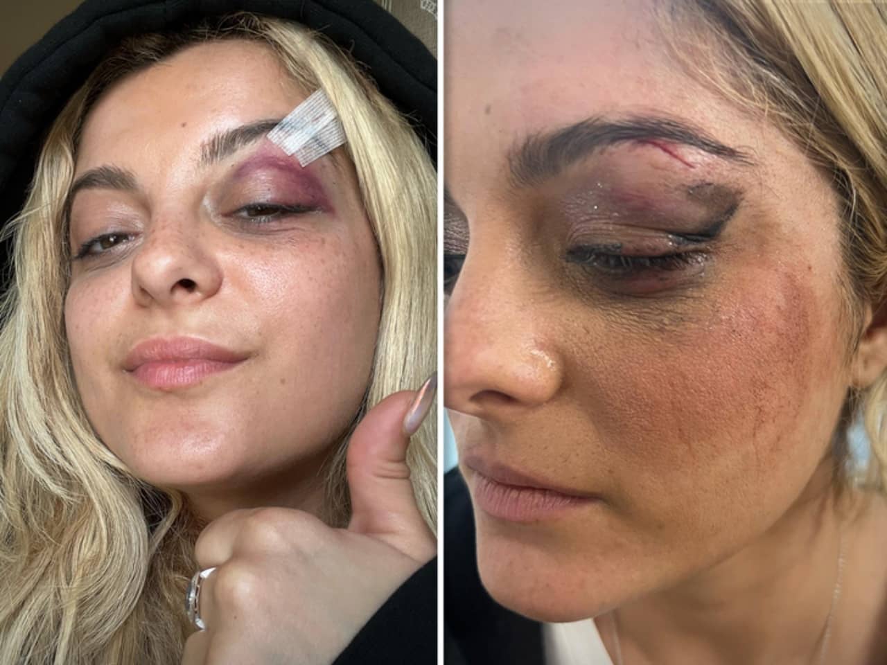 Bebe Rexha saldırı sonrası görüntüsü